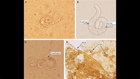 Strongyloides stercoralis - morphology, life cycle, pathogenesis ...