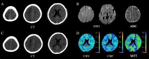 Cortical sulcal effacement on brain CT associated with cerebral hyperperfusion after carotid ...