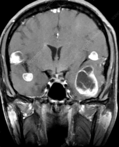 Melanoma Metastatic to Brain, MRI - Stock Image - C039/4207 - Science Photo Library