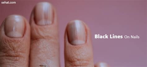 Black Lines On Fingernails Mean