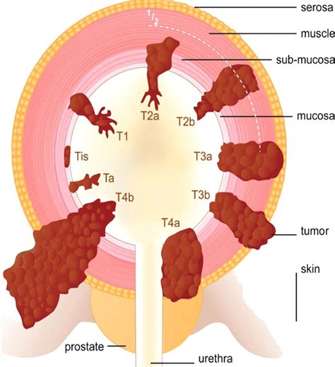 Urinary Bladder Cancer: Role of MR Imaging | RadioGraphics