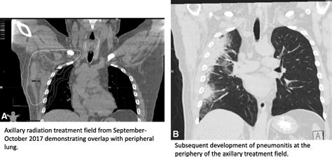 Pneumonitis resulting from radiation and immune checkpoint blockade illustrates characteristic ...