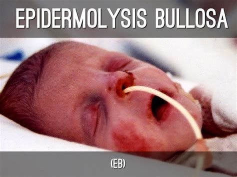 Epidermolysis Bullosa Simplex Wikipedia