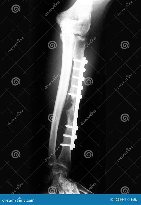 X-Rayed Forearm stock image. Image of negative, bones - 1261441