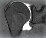 My Rotator Cuff MRI Shoulder Scan and Arthrogram (MRA)