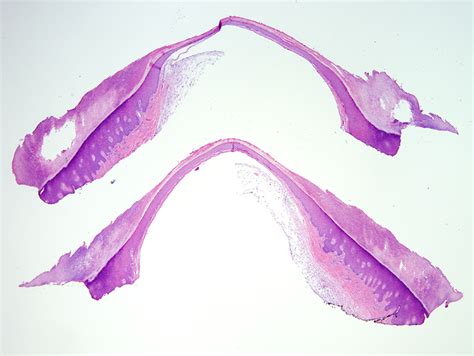 Digital Mucous Cyst | Dermatopathology