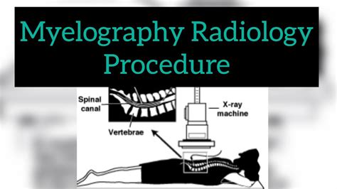 Myelogram procedure | Radiology Procedure | Radiographer | lumbar puncture | ct | xray real ...
