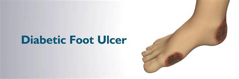 Diabetic Foot Ulcers: Causes, Symptoms, Treatment & Prevention