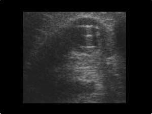 Urinary Tract and male reproductive system | 2.1 Kidney and ureter : Case 2.1.3 Renal cysts ...