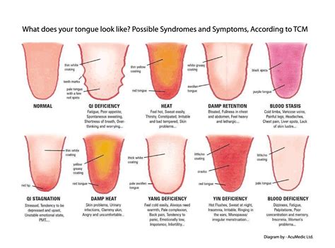 How to Diagnose a Tongue in Traditional Chinese Medicine — The Wellness ...