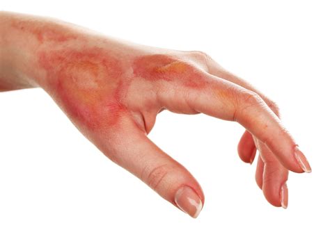 Three Signs a Burn Is Infected and When to Visit Your Local Urgent Care | Oxford Urgent Care