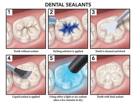 Children Teeth Sealants | Timbercrest Dental Center, Appleton WI