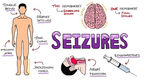 Seizures - Seizure Types | Generalized vs Focal Seizures | Causes of ...