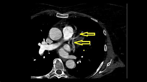 Anomalous Origin of the Right Coronary Artery From the Mid-Portion of the Left Anterior ...