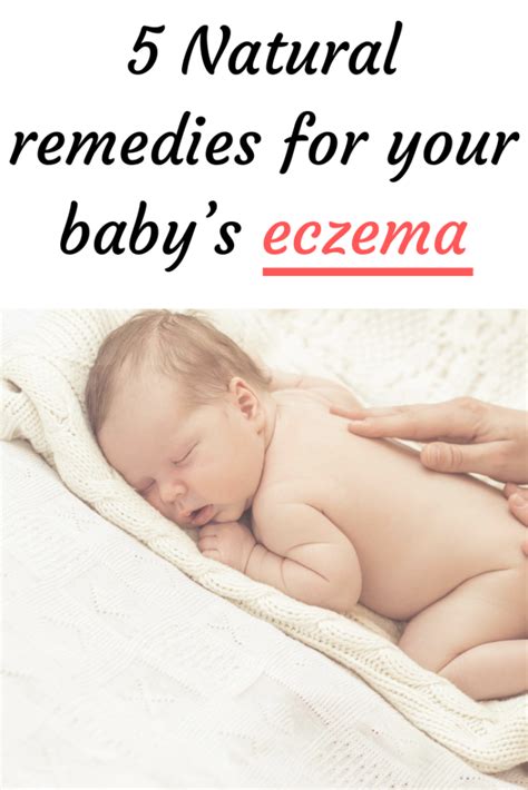 5 Natural remedies for your baby’s eczema | Eczema, Eczema remedies