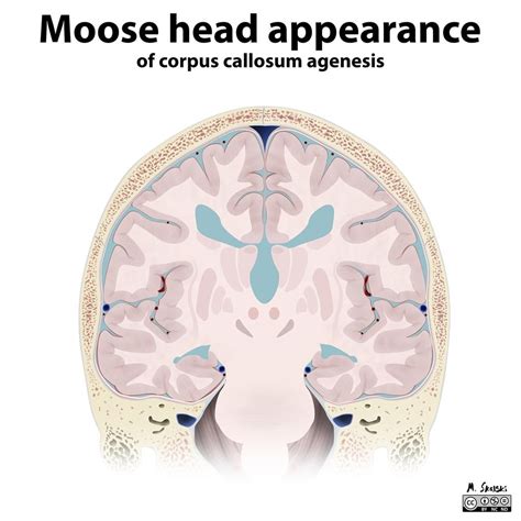 Corpus callosum agenesis illustrations | Radiology Case | Radiopaedia ...