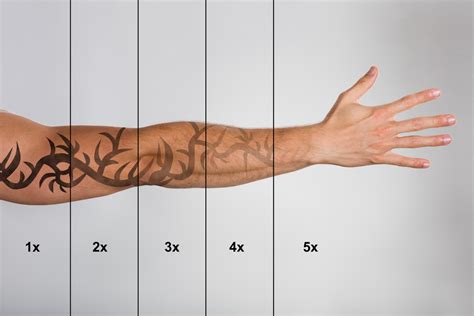 How Long Does Laser Tattoo Removal Take? | Bala Aesthetics