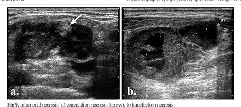 Ultrasound Benign Lymph Nodes Neck