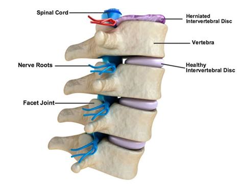 Can I Lift Weights With A Herniated Disc?