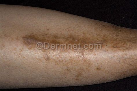 Diabetic Dermopathy: Overview and Pictures