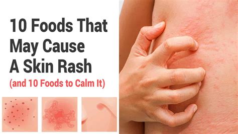 10 Foods That May Cause A Skin Rash (and 10 Foods to Calm It)