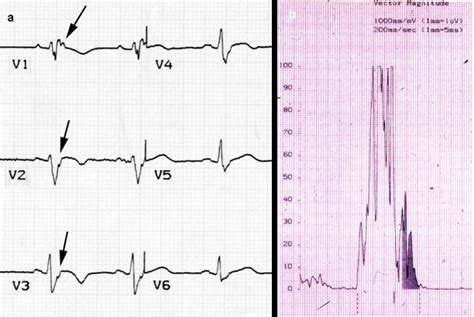 Pedi cardiology: EKG: Epsilon Wave