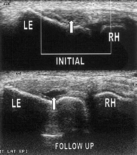 Partial-thickness tear, common extensor tendon. Longitudinal image... | Download Scientific Diagram