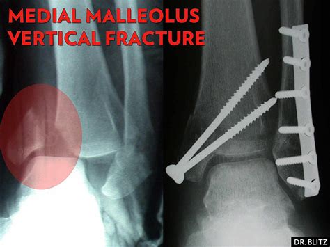 5 Kinds of Medial Malleolus Ankle Fractures