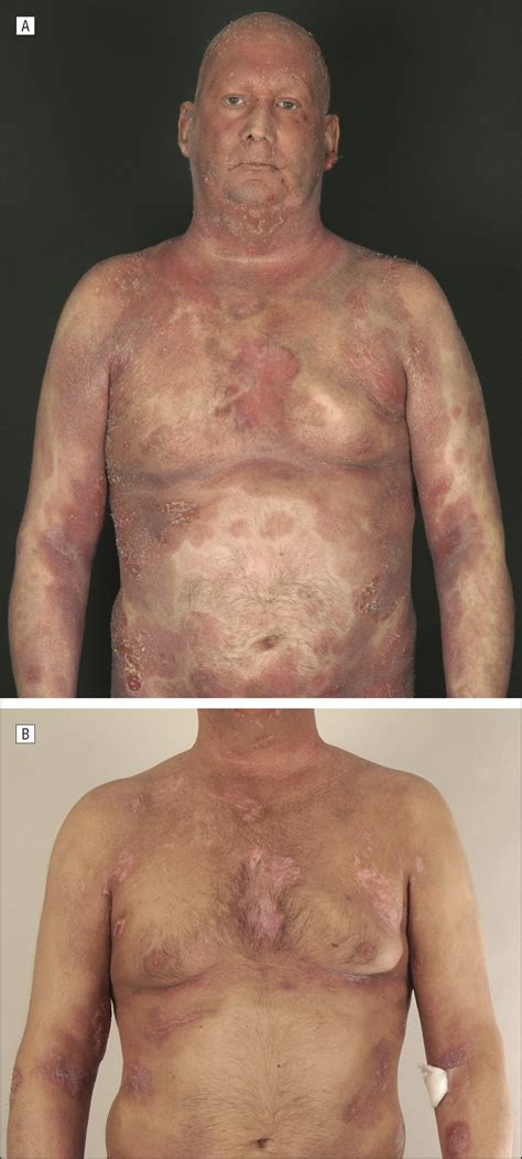 Exacerbation of Undiagnosed Mycosis Fungoides During Treatment With Etanercept | Dermatology ...