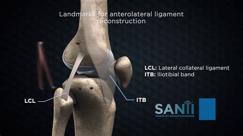 Acl reconstruction - familyharew