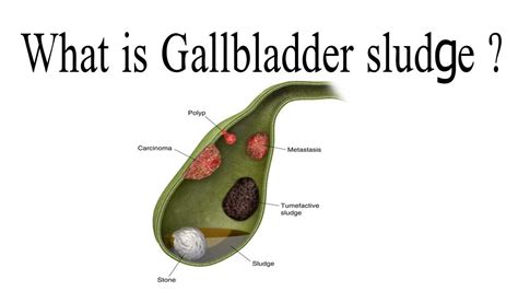 Can You Develop Biliary Sludge Without A Gallbladder?