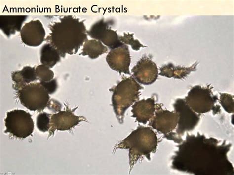 Ammonium biurate Crystals | Medical Laboratories