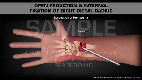 Open Reduction Internal Fixation Of Right Distal Radius – Otosection