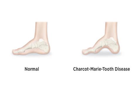 Symptoms Of Charcot Foot Disease