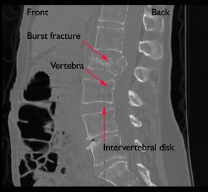 Home: Patah pada tulang belakang / spine fracture