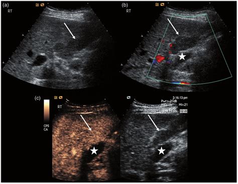 Focal fatty sparing on: (a) grey scale, (b) colour Doppler and (c) CEUS... | Download Scientific ...