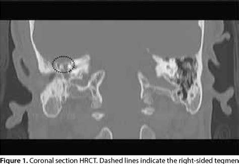 Figure 1 from Repair of Tegmen Tympani Defect Presenting with Spontaneous Cerebrospinal Fluid ...