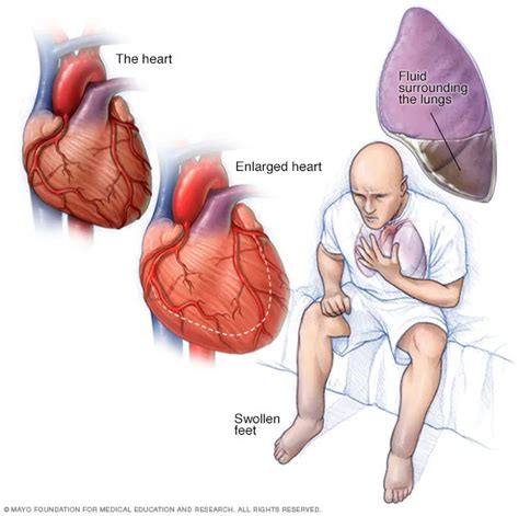 Heart Failure: Causes and Risk Factors - AIR-CLINIC