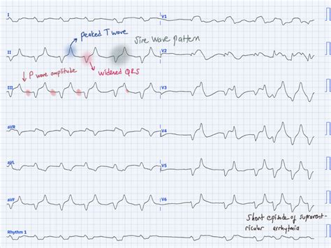 sine wave pattern – Cardiosketch