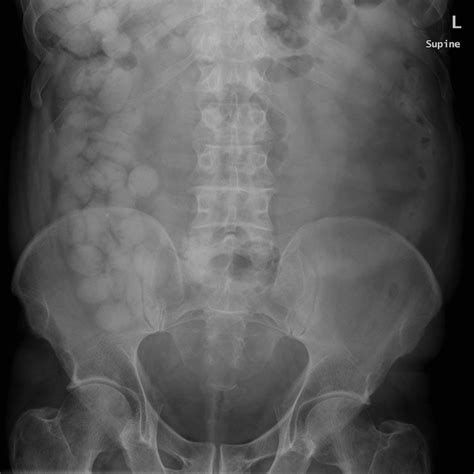 -X-ray abdomen supine shows typical tic-tac sign packets within large ...