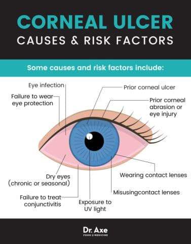 Corneal Ulcer Symptoms + Relieve Symptoms 11 Natural Ways - Dr. Axe