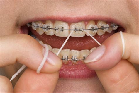 How to floss with braces on? | News | Dentagama