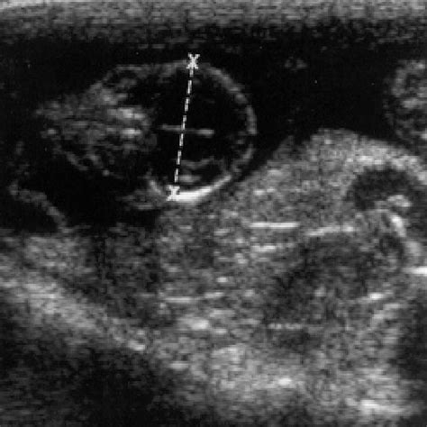 (PDF) Ultrasound measurement of biparietal diameter and umbilical artery blood flow in the ...