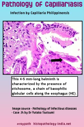 Pathology of Capillariasis - Dr Sampurna Roy MD