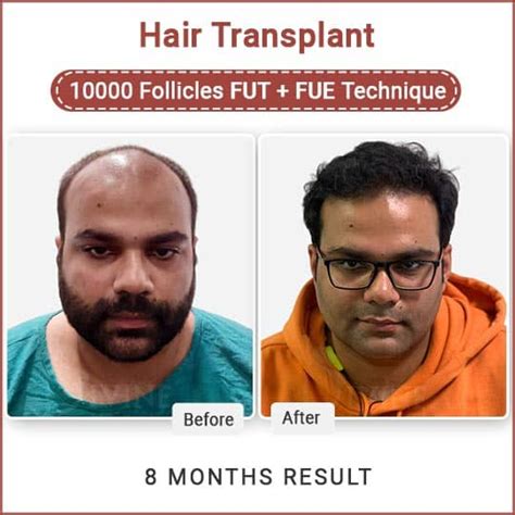 Hair Transplant Before and After | Hair Transplant Surgery Results