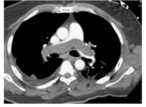 Saddle Pulmonary Embolism Xray