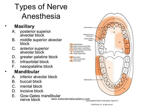 local anesthesia / /certified fixed orthodontic courses by Indian d…