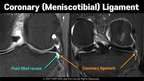 Coronary Ligament Knee