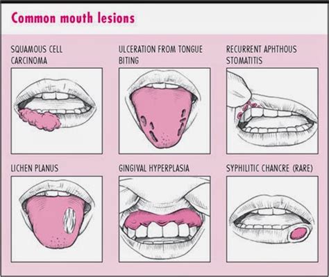 what cause blisters in the mouth - pictures, photos