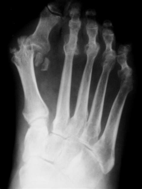 Rheumatoid Arthritis X Ray Foot